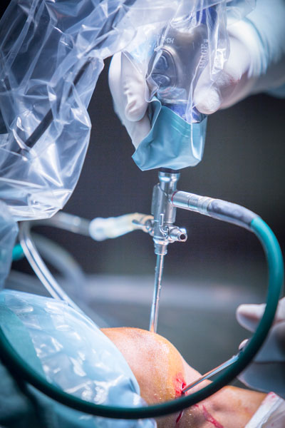 EXTRACAO CELULA TRONCO | Dra. Aneliza Vittorazzi especialista em medicina regenerativa, alopecia androgenética e queimaduras