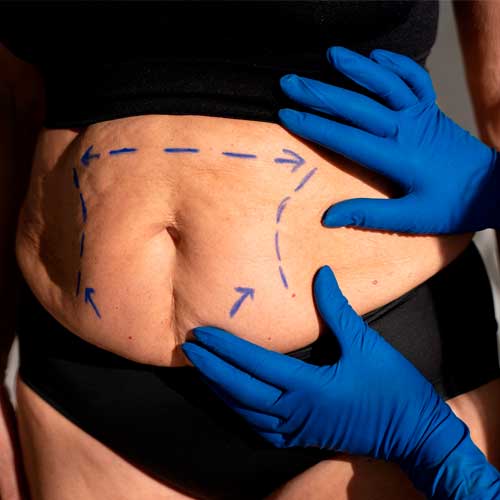 exame para cirurgia plastica corporal | Dra. Aneliza Vittorazzi especialista em medicina regenerativa, alopecia androgenética e queimaduras