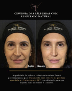  Blefaroplastia superior e inferior com lifting de supercílios.png