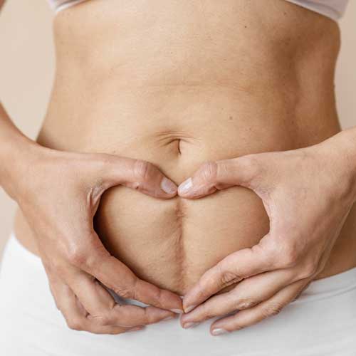 cicatriz vrtical no ventre | Dra. Aneliza Vittorazzi especialista em medicina regenerativa, alopecia androgenética e queimaduras