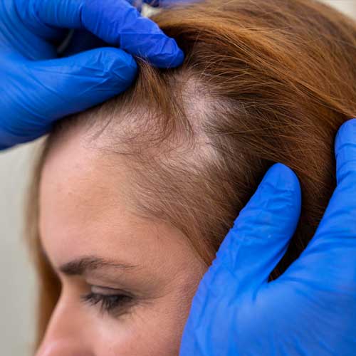 exame para tratamento de alopecia | Dra. Aneliza Vittorazzi especialista em medicina regenerativa, alopecia androgenética e queimaduras