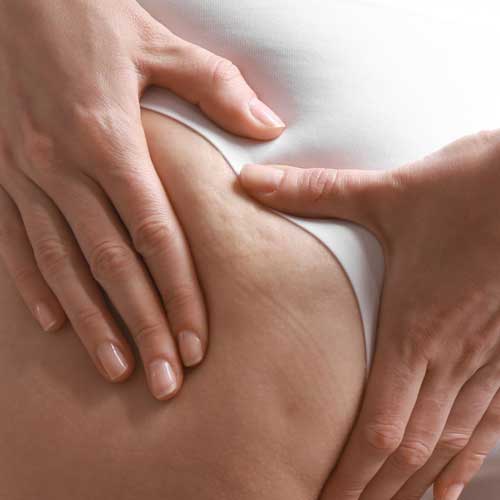 lipedema | Dra. Aneliza Vittorazzi especialista em medicina regenerativa, alopecia androgenética e queimaduras