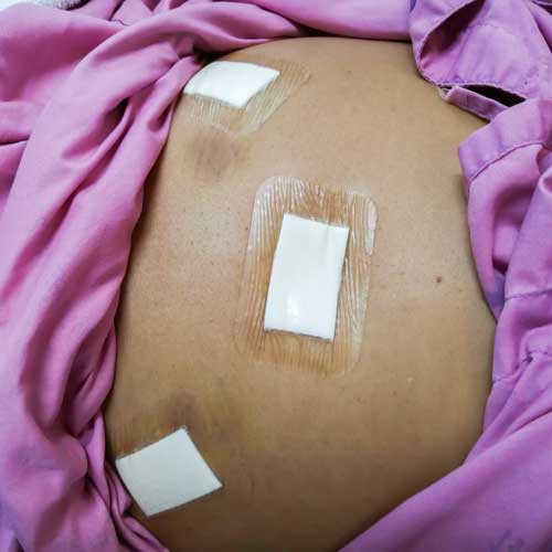 pos operada necessitando tratamento cirurgia plastica | Dra. Aneliza Vittorazzi especialista em medicina regenerativa, alopecia androgenética e queimaduras