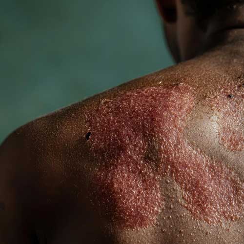 queimadura de pele | Dra. Aneliza Vittorazzi especialista em medicina regenerativa, alopecia androgenética e queimaduras