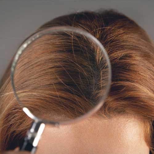 couro cabeludo sendo | Dra. Aneliza Vittorazzi especialista em medicina regenerativa, alopecia androgenética e queimaduras