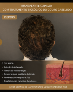 tratamento regenerativo couro cabeludo calvicie regeneracao capilar dra aneliza vittorazzi 3 | Dra. Aneliza Vittorazzi especialista em medicina regenerativa, alopecia androgenética e queimaduras