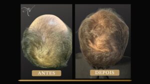 Comparação clínica ilustrando a evolução da densidade capilar de paciente acompanhada pela Dra. Aneliza Vittorazzi após tratamento individualizado.