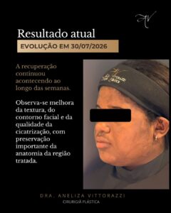 Caso clínico: evolução de uma queimadura facial grave tratada com medicina regenerativa | Dra. Aneliza Vittorazzi | Medicina Regenerativa tratamento queimados com celulas tronco especialista dra aneliza vittorazzi cirurgia plastica ribeirao pre 1 | Dra. Aneliza Vittorazzi especialista em medicina regenerativa, alopecia androgenética e queimaduras