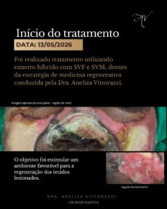 Caso clínico: evolução de uma queimadura facial grave tratada com medicina regenerativa | Dra. Aneliza Vittorazzi | Medicina Regenerativa tratamento queimados com celulas tronco especialista dra aneliza vittorazzi cirurgia plastica ribeirao pre 4 | Dra. Aneliza Vittorazzi especialista em medicina regenerativa, alopecia androgenética e queimaduras