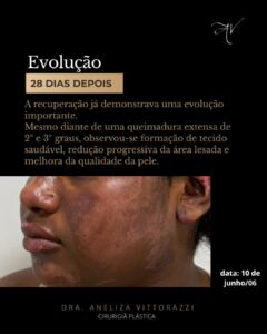 Caso clínico: evolução de uma queimadura facial grave tratada com medicina regenerativa | Dra. Aneliza Vittorazzi | Medicina Regenerativa tratamento queimados com celulas tronco especialista dra aneliza vittorazzi cirurgia plastica ribeirao pre 5 | Dra. Aneliza Vittorazzi especialista em medicina regenerativa, alopecia androgenética e queimaduras